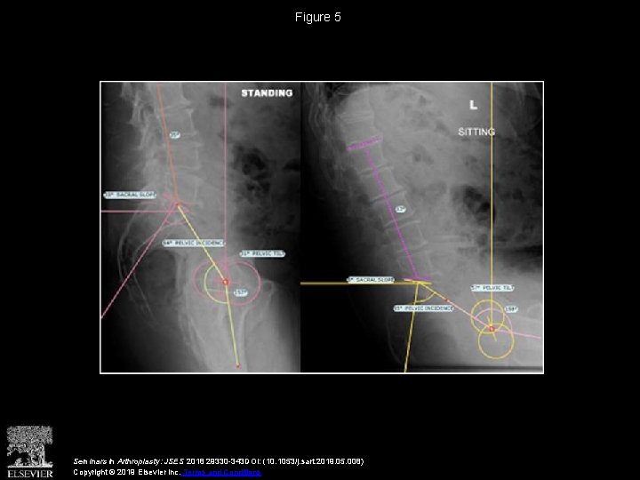 Figure 5 Seminars in Arthroplasty: JSES 2018 29330 -343 DOI: (10. 1053/j. sart. 2019.