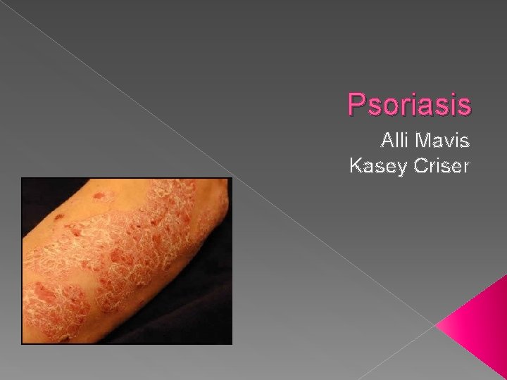 Psoriasis Alli Mavis Kasey Criser 