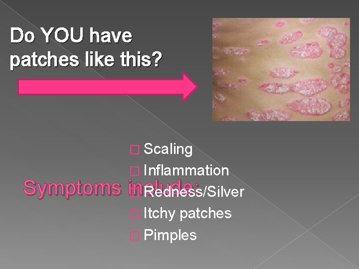 Do YOU have patches like this? � Scaling � Inflammation Symptoms include: � Redness/Silver