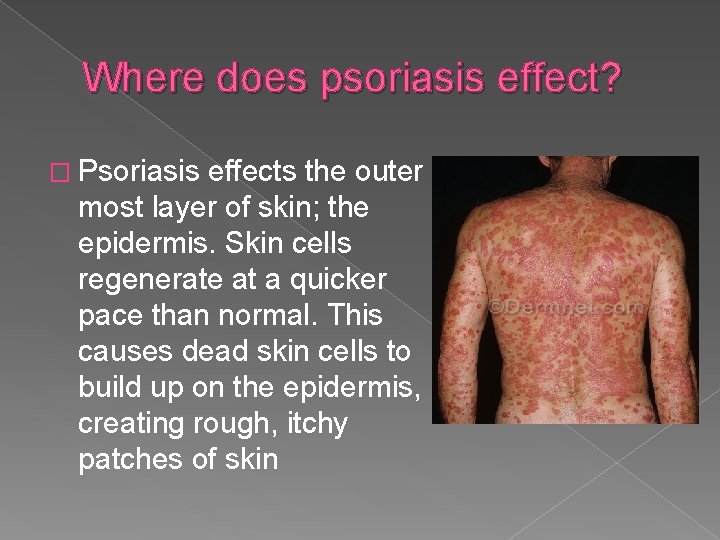 Where does psoriasis effect? � Psoriasis effects the outer most layer of skin; the