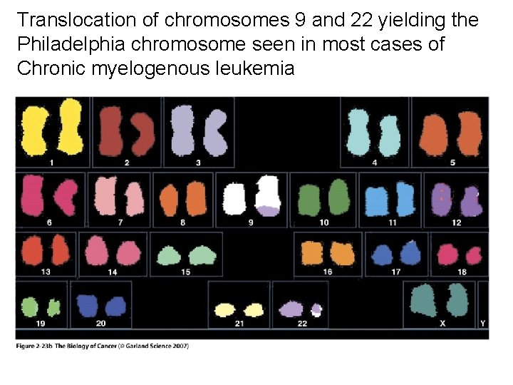 Translocation of chromosomes 9 and 22 yielding the Philadelphia chromosome seen in most cases