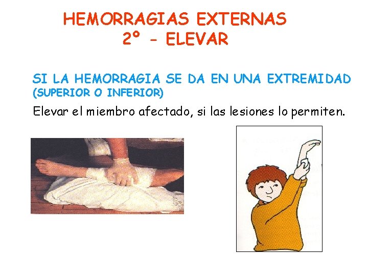 HEMORRAGIAS EXTERNAS 2º - ELEVAR SI LA HEMORRAGIA SE DA EN UNA EXTREMIDAD (SUPERIOR