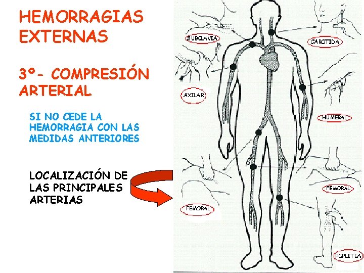 HEMORRAGIAS EXTERNAS 3º- COMPRESIÓN ARTERIAL SI NO CEDE LA HEMORRAGIA CON LAS MEDIDAS ANTERIORES