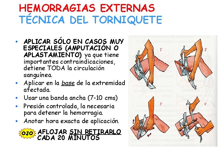 HEMORRAGIAS EXTERNAS TÉCNICA DEL TORNIQUETE w w w APLICAR SÓLO EN CASOS MUY ESPECIALES