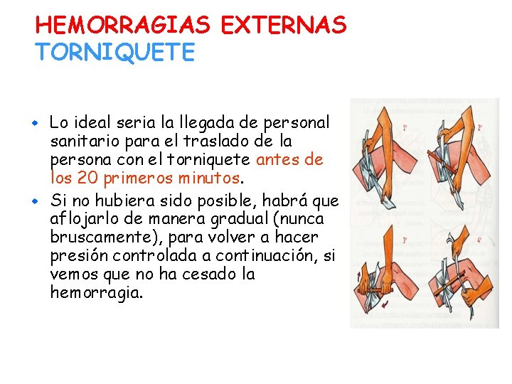 HEMORRAGIAS EXTERNAS TORNIQUETE Lo ideal seria la llegada de personal sanitario para el traslado