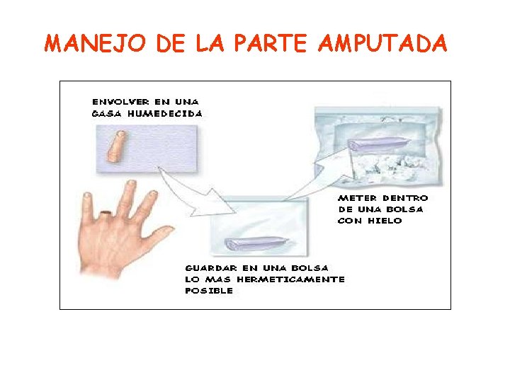 MANEJO DE LA PARTE AMPUTADA 