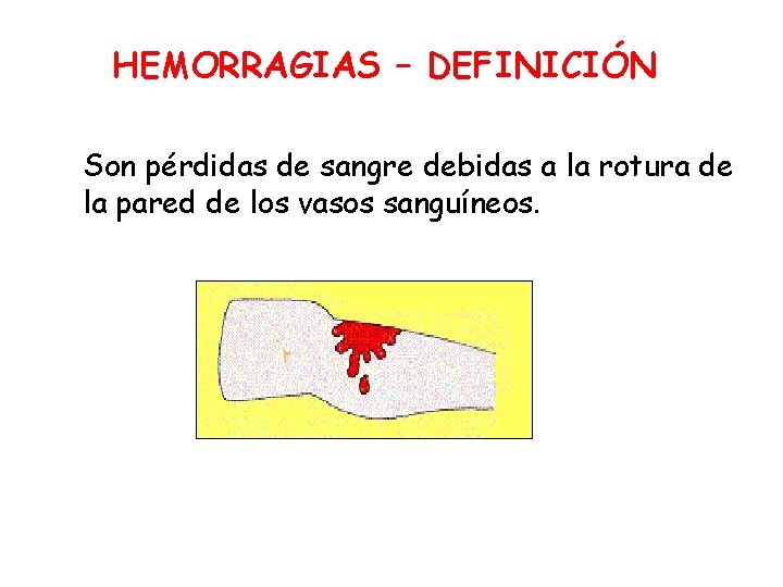 HEMORRAGIAS – DEFINICIÓN Son pérdidas de sangre debidas a la rotura de la pared