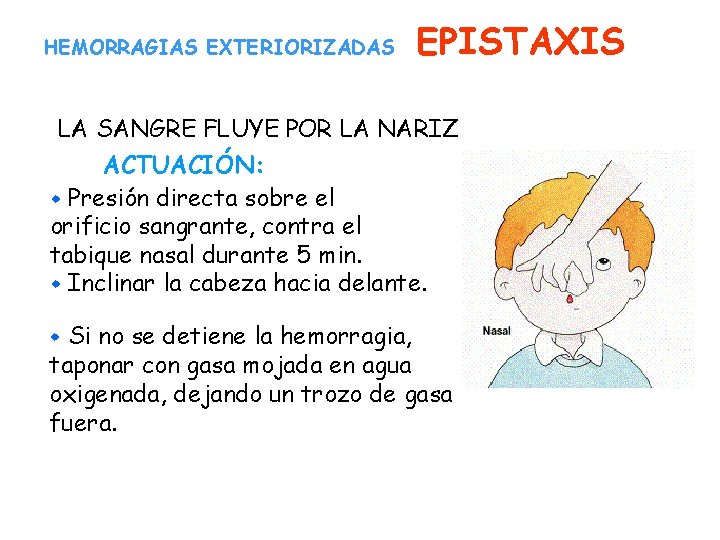 HEMORRAGIAS EXTERIORIZADAS EPISTAXIS LA SANGRE FLUYE POR LA NARIZ ACTUACIÓN: w Presión directa sobre