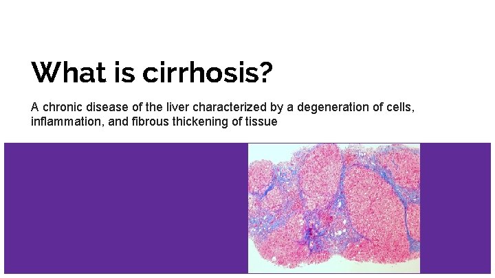 What is cirrhosis? A chronic disease of the liver characterized by a degeneration of