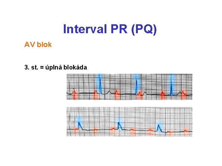 Interval PR (PQ) AV blok 3. st. = úplná blokáda 