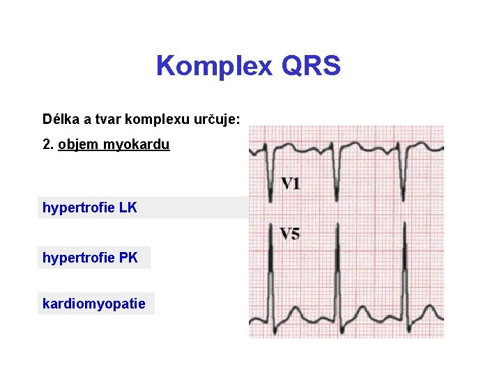Komplex QRS Délka a tvar komplexu určuje: 2. objem myokardu hypertrofie LK hypertrofie PK