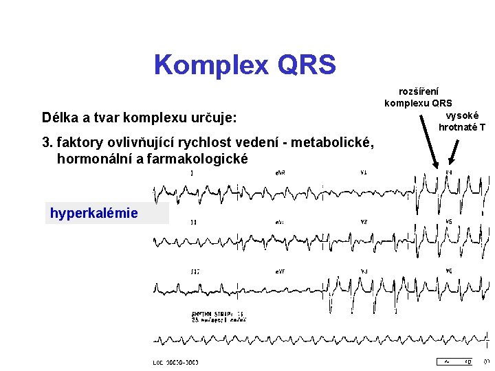 Komplex QRS Délka a tvar komplexu určuje: 3. faktory ovlivňující rychlost vedení - metabolické,