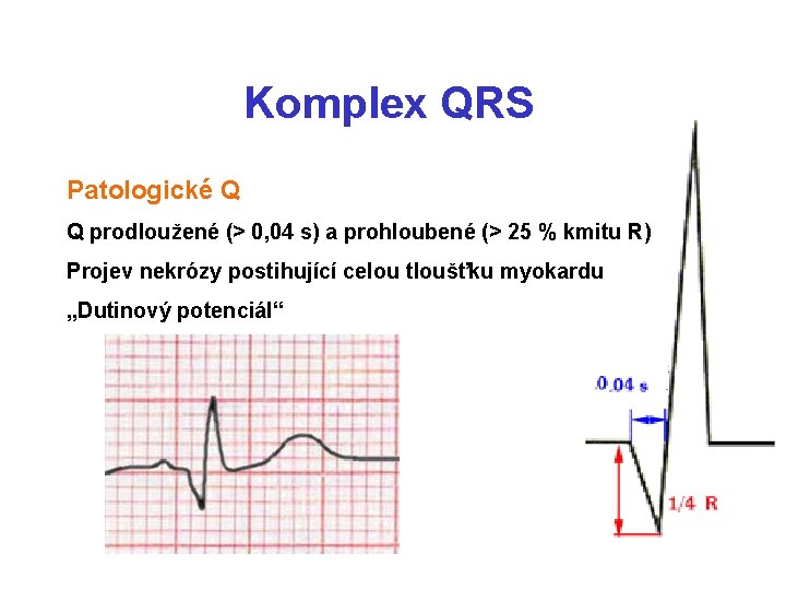 Komplex QRS Patologické Q Q prodloužené (> 0, 04 s) a prohloubené (> 25