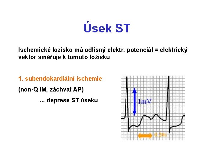 Úsek ST Ischemické ložisko má odlišný elektr. potenciál = elektrický vektor směřuje k tomuto