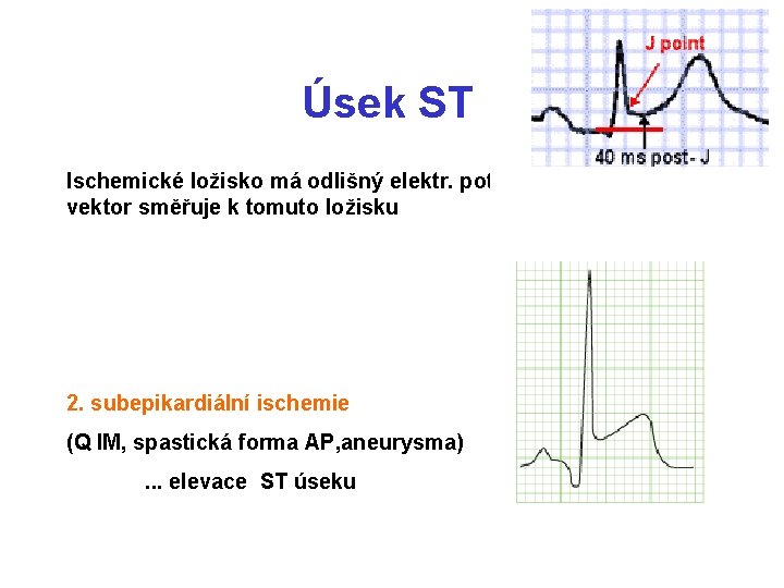 Úsek ST Ischemické ložisko má odlišný elektr. potenciál = elektrický vektor směřuje k tomuto