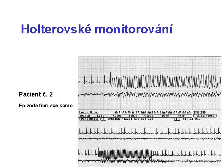 Holterovské monitorování Pacient č. 2 Epizoda fibrilace komor 