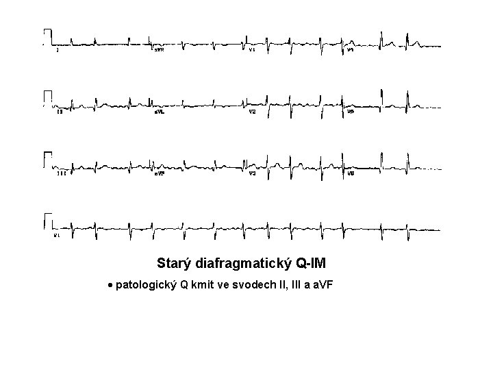 Starý diafragmatický Q-IM · patologický Q kmit ve svodech II, III a a. VF