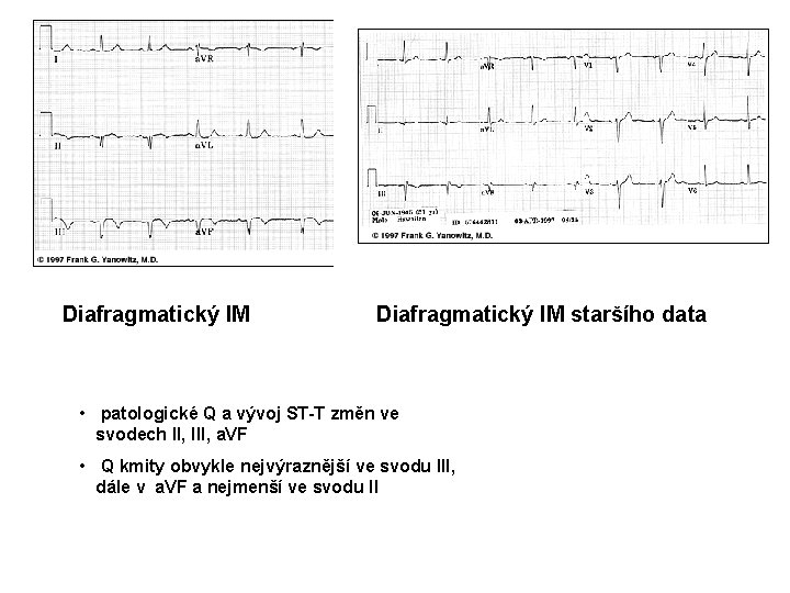 Diafragmatický IM staršího data • patologické Q a vývoj ST-T změn ve svodech II,