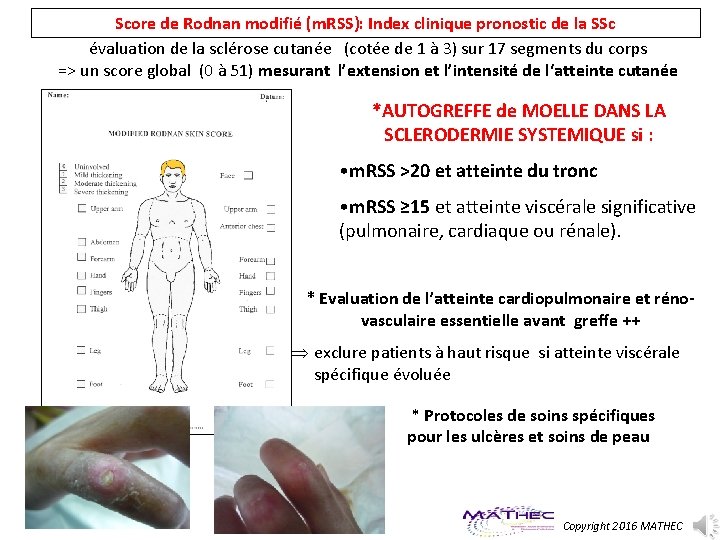 Score de Rodnan modifié (m. RSS): Index clinique pronostic de la SSc évaluation de