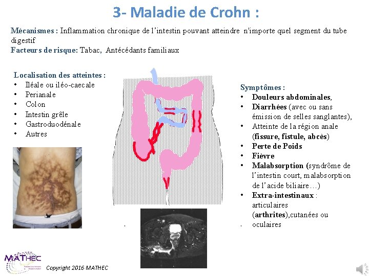 3 - Maladie de Crohn : Mécanismes : Inflammation chronique de l’intestin pouvant atteindre