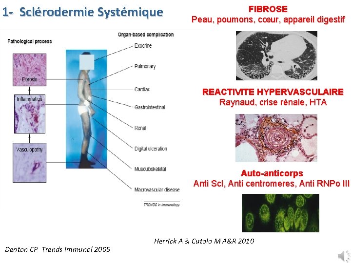 1 - Sclérodermie Systémique FIBROSE Peau, poumons, cœur, appareil digestif REACTIVITE HYPERVASCULAIRE Raynaud, crise