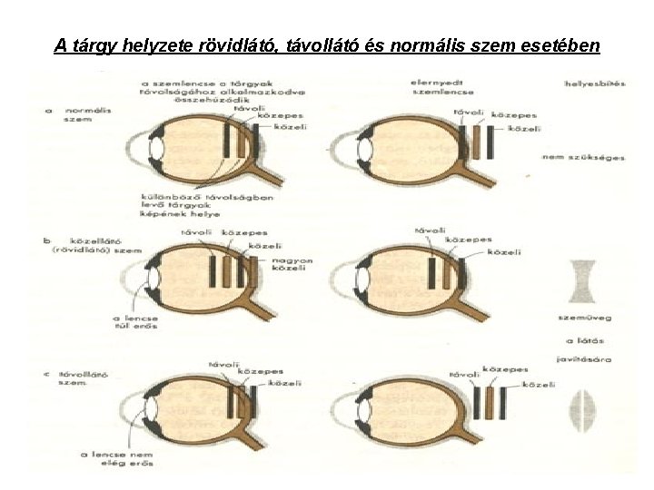 A tárgy helyzete rövidlátó, távollátó és normális szem esetében 