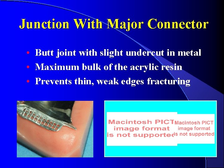 Junction With Major Connector • Butt joint with slight undercut in metal • Maximum