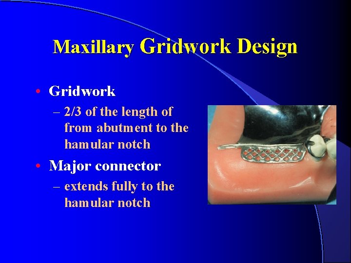 Maxillary Gridwork Design • Gridwork – 2/3 of the length of from abutment to