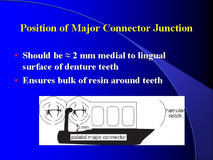 Position of Major Connector Junction • Should be ≈ 2 mm medial to lingual