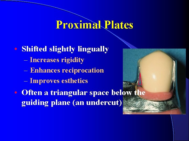 Proximal Plates • Shifted slightly lingually – Increases rigidity – Enhances reciprocation – Improves