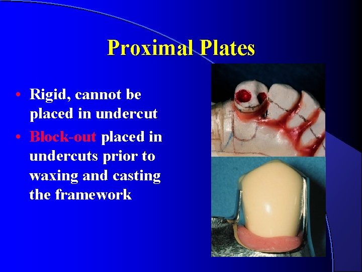 Proximal Plates • Rigid, cannot be placed in undercut • Block-out placed in undercuts