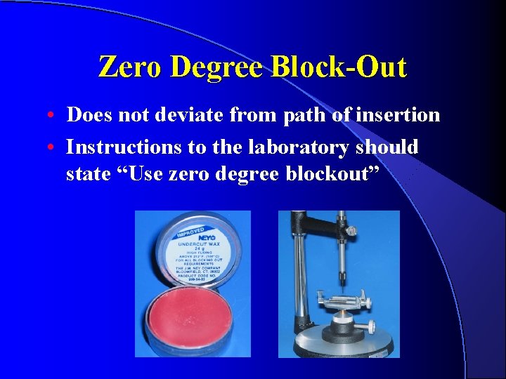 Zero Degree Block-Out • Does not deviate from path of insertion • Instructions to