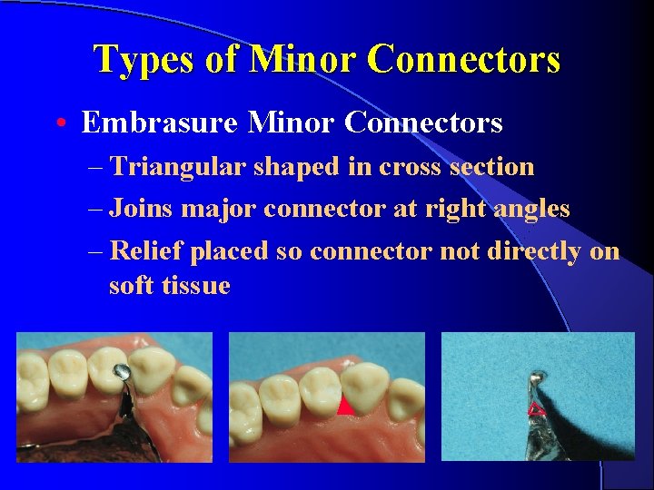 Types of Minor Connectors • Embrasure Minor Connectors – Triangular shaped in cross section