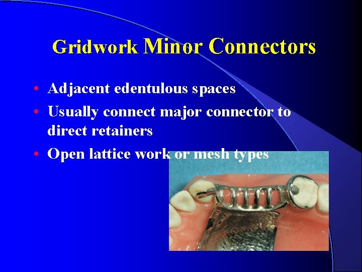 Gridwork Minor Connectors • Adjacent edentulous spaces • Usually connect major connector to direct