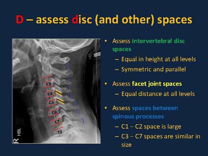D – assess disc (and other) spaces • Assess intervertebral disc spaces – Equal