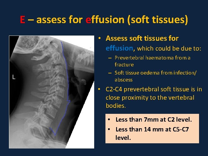 E – assess for effusion (soft tissues) • Assess soft tissues for effusion, which