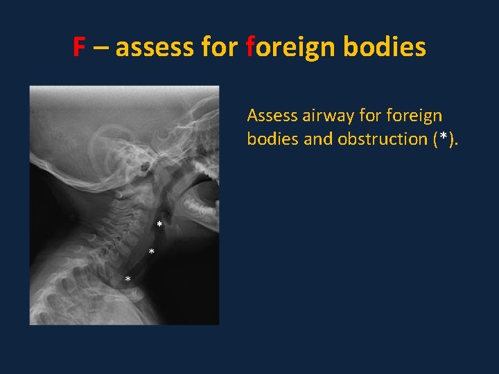 F – assess foreign bodies Assess airway foreign bodies and obstruction (*). 