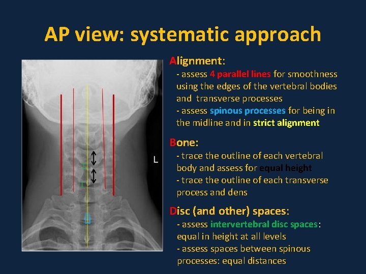 AP view: systematic approach Alignment: - assess 4 parallel lines for smoothness using the