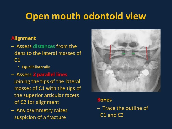 Open mouth odontoid view Alignment – Assess distances from the dens to the lateral