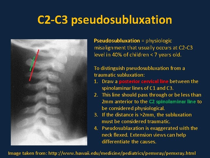 C 2 -C 3 pseudosubluxation Pseudosubluxation = physiologic misalignment that usually occurs at C
