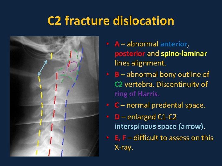 C 2 fracture dislocation • A – abnormal anterior, posterior and spino-laminar lines alignment.