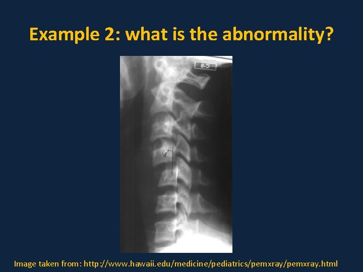 Example 2: what is the abnormality? Image taken from: http: //www. hawaii. edu/medicine/pediatrics/pemxray. html