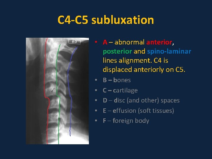 C 4 -C 5 subluxation • A – abnormal anterior, posterior and spino-laminar lines