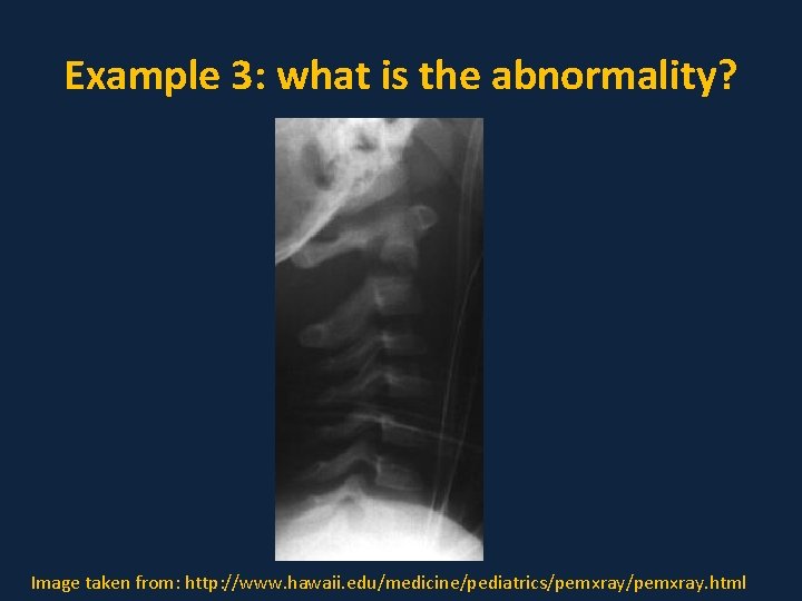 Example 3: what is the abnormality? Image taken from: http: //www. hawaii. edu/medicine/pediatrics/pemxray. html