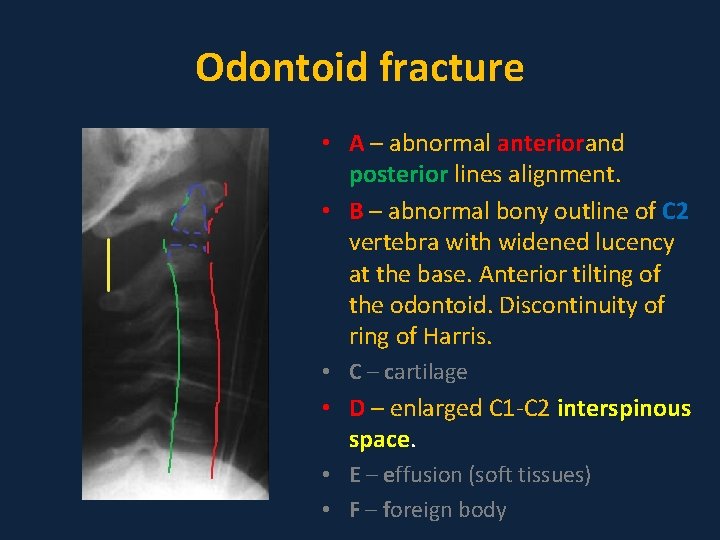 Odontoid fracture • A – abnormal anteriorand posterior lines alignment. • B – abnormal