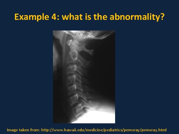 Example 4: what is the abnormality? Image taken from: http: //www. hawaii. edu/medicine/pediatrics/pemxray. html