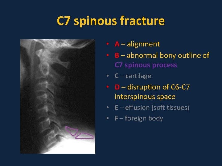 C 7 spinous fracture • A – alignment • B – abnormal bony outline