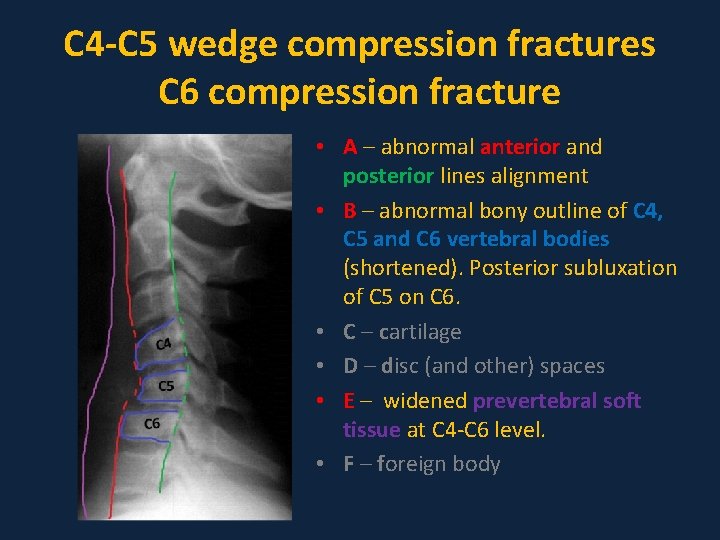 C 4 -C 5 wedge compression fractures C 6 compression fracture • A –