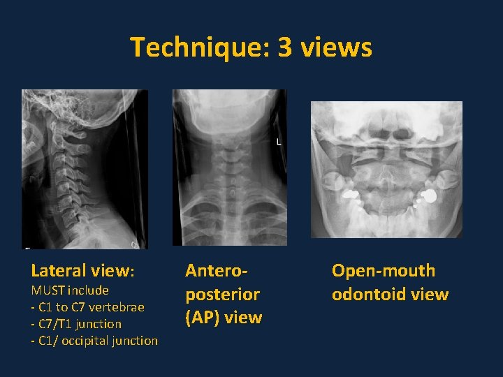 Technique: 3 views Lateral view: MUST include - C 1 to C 7 vertebrae