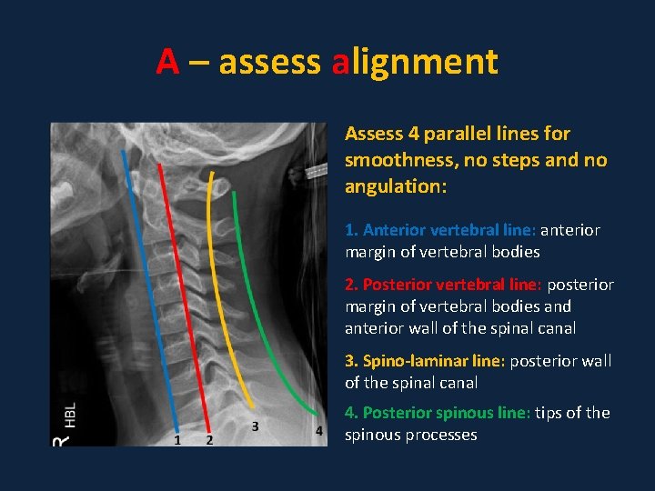 A – assess alignment Assess 4 parallel lines for smoothness, no steps and no